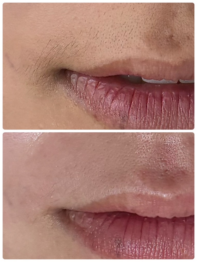 顔WAX 症例写真 1